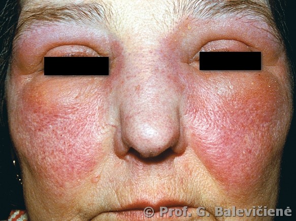 Alerginis kontaktinis dermatitas. Simptomai, priežastys, eiga ir gydymas - joomla123.lt