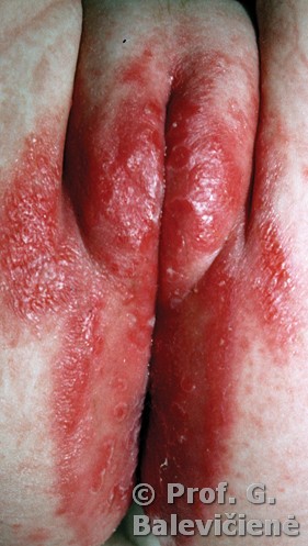 Plaukų folikulų uždegimas varpos odoje - Kosmetologė
